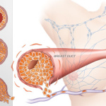 breast-cancer-stages